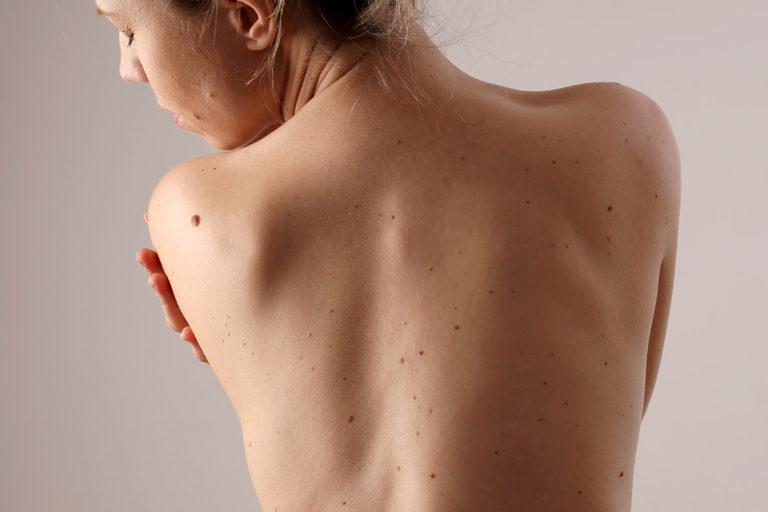 femme nue vue de dos et qui as plusieurs grains de beauté dans le dos